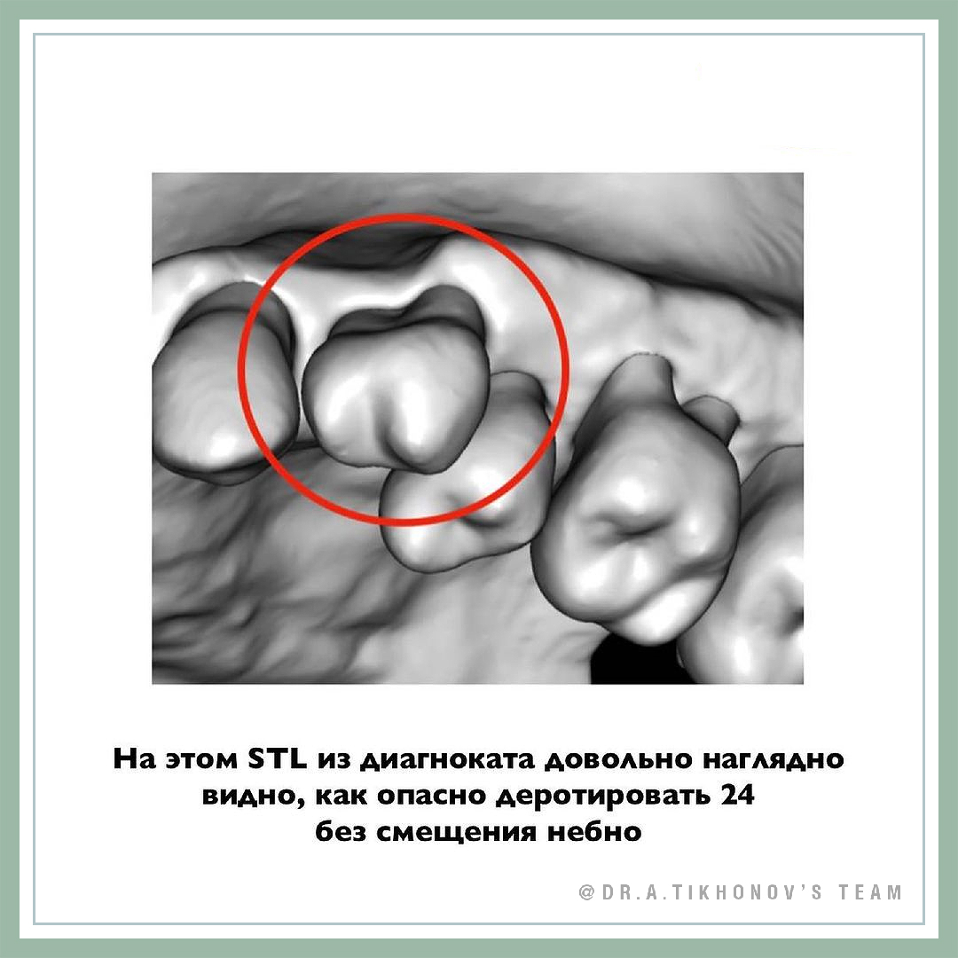 История «спасения» одного премоляра. - интересно об ортодонтии, имплантации  и протезировании зубов